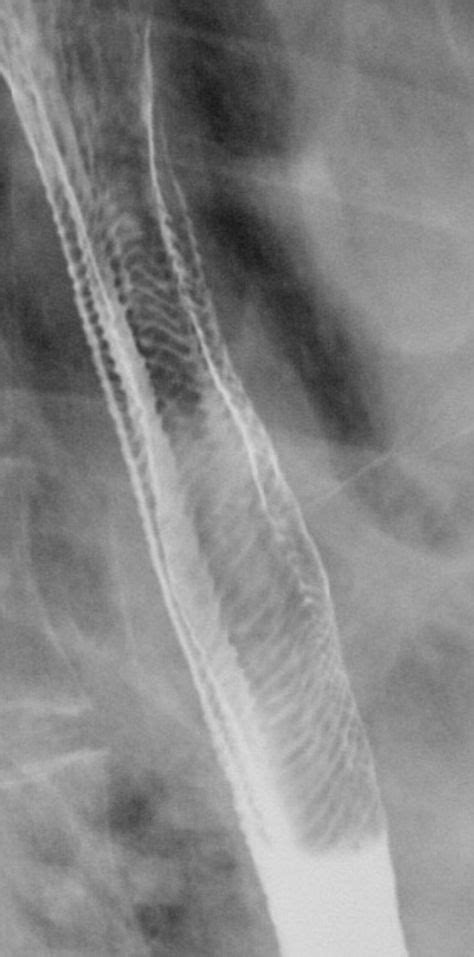 Feline oesophagus - transient transverse bands seen in the mid and lower oesophagus on a double ...