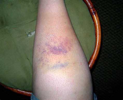 Epic Bruise is Epic | Leg bruise 2: This thing is better tha… | Flickr