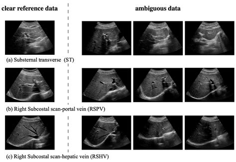 Real-Time Deep Recognition of Standardized Liver Ultrasound Scan Locations