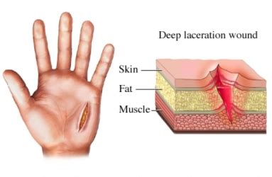 American football injuries