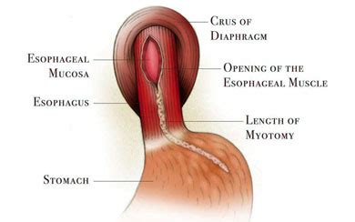 Laparoscopic Heller Myotomy | Memorial Hermann