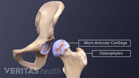 Osteophytes Hip