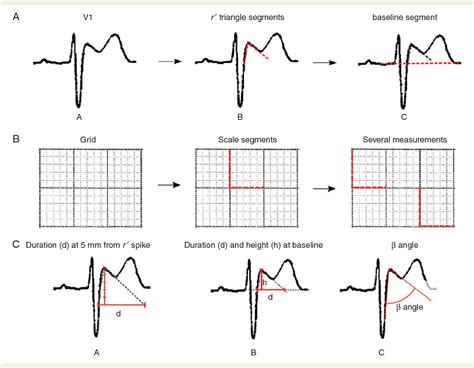 Figure 1 from New electrocardiographic criteria to differentiate the ...