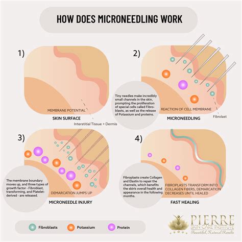 Microneedling | Thousand Oaks | Pierre Skin Care Institute