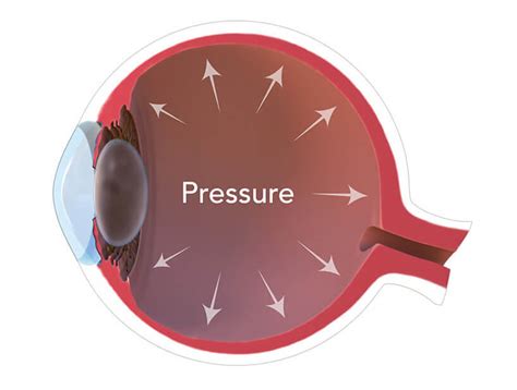 Ocular Hypertension: A Comprehensive Guide to Causes, Symptoms, and Treatment - Mama Knows Best