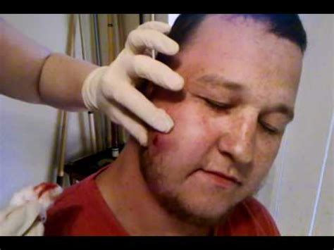 Justin getting his face lanced - YouTube