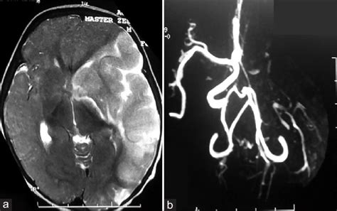 (a and b) MRI brain and MR angiography of the index case. (a) MRI brain... | Download Scientific ...