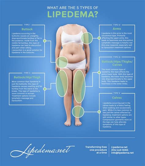 Pin on Lipedema