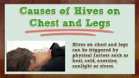 Hives on Chest - Hives on Chest and Legs - Hives on Arms and Legs ...