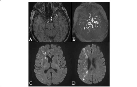 a-d: MRI of the same patient demonstrates occlusion of right ICA with ...