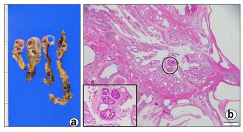 Diagnostics | Free Full-Text | A Case of Early-Stage Gallbladder Cancer, Positive for ALDH1A1 ...