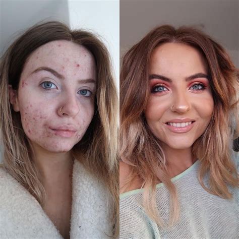 This foundation is going viral after cystic acne sufferer shares her amazing before-and-after ...