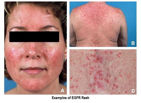 Chemo Rash & EGFR Rash Treatment - Lindi Skin