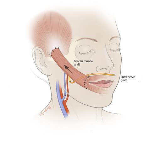 Gracilis Microvascular Facial Reanimation – Oto Surgery Atlas