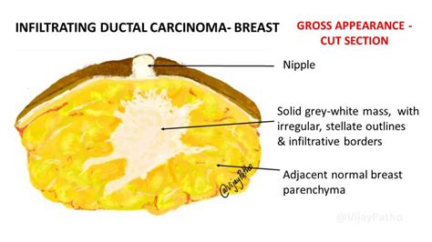 Invasive Ductal Carcinoma Diagram