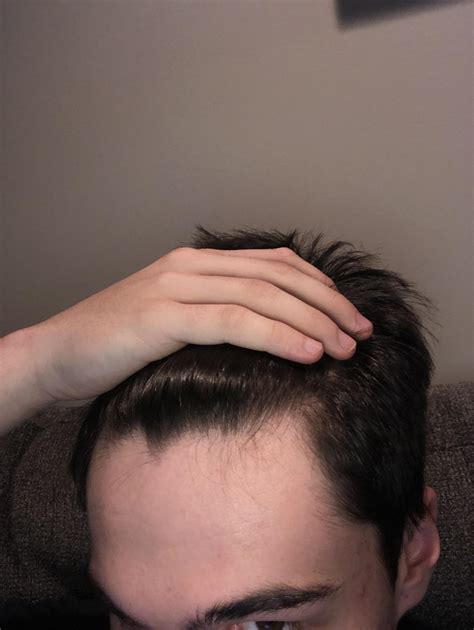 Maturing hairline?? Or am I balding??? Im 18 years old : r/Haircare