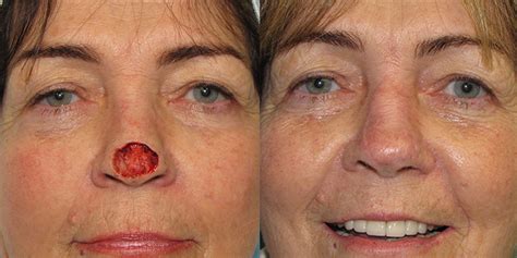 Nose Reconstruction Gallery | Skin Cancer And Reconstructive Surgery Center