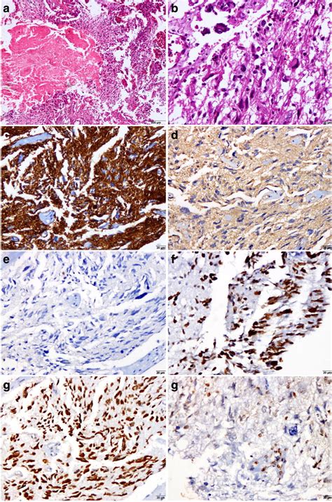 Histology and immunohistochemical profile from a 15-year-old pediatric ...