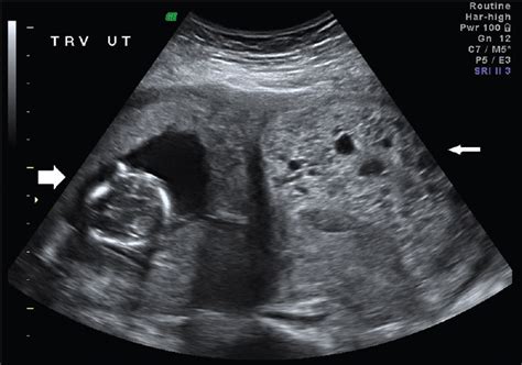 Bicornuate Uterus Ultrasound