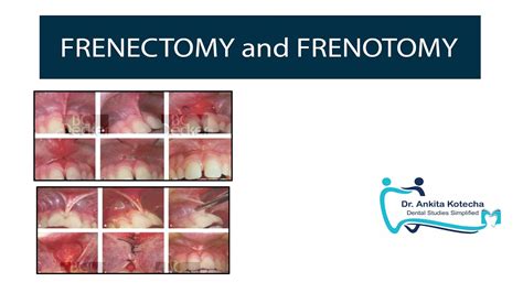 FRENECTOMY and FRENOTOMY| TREATMENT OF ABERRANT FRENUM| PERIODONTAL PLASTIC AND ESTHETIC SURGERY ...