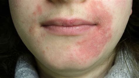 Rash Around My Lips Allergic Reaction Treatment | Lipstutorial.org