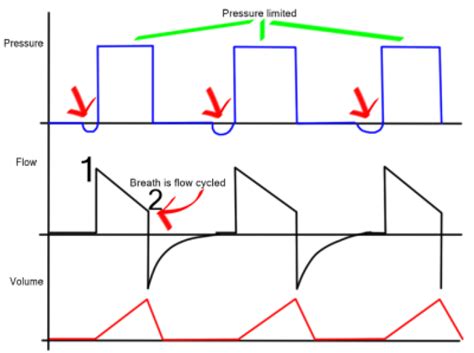 Pressure Support Ventilation Curves - Critical Care Practitioner