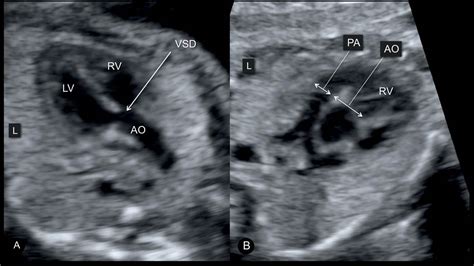 Tetralogy of Fallot, Pulmonary Atresia with Ventricular Septal Defect, and Absent Pulmonary ...