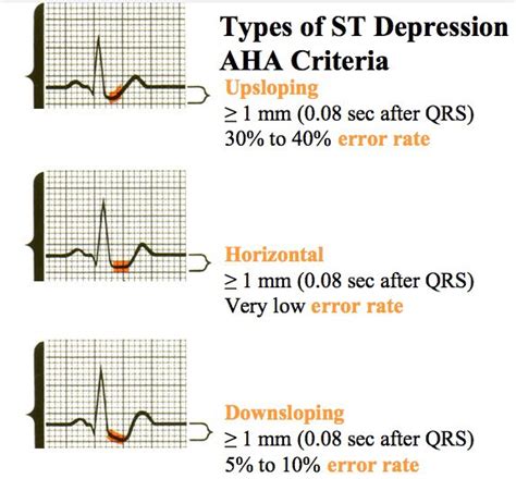 Medical Addicts: Types of ST Depression on ECG