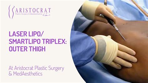 Laser Lipo/ SmartLipo Triplex: Outer Thigh - YouTube