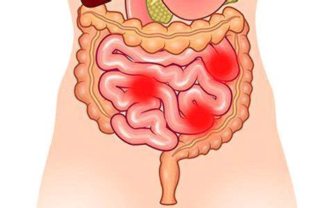 Enteritis: causes, symptoms and treatment – Healthy Food Near Me