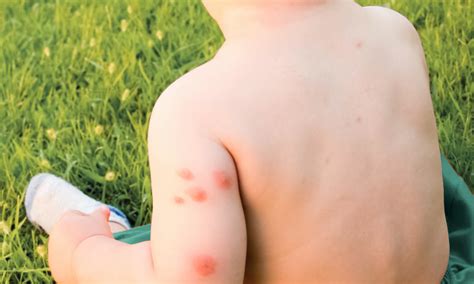 Mosquito Bites Pictures Allergic Reaction