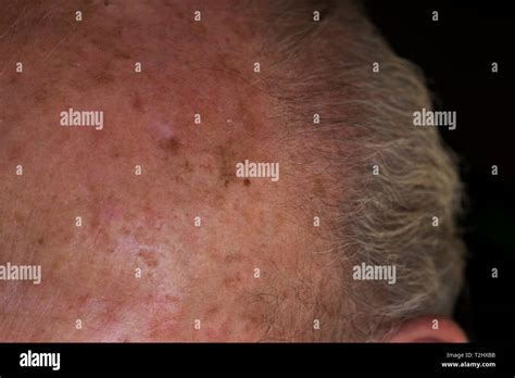 Carcinoma melanoma skin damage on elderly mans forehead from sun ...