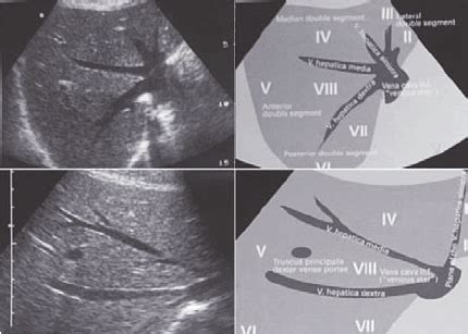 Interactive illustrated ultrasound showing a Couinaud segmentation on ...