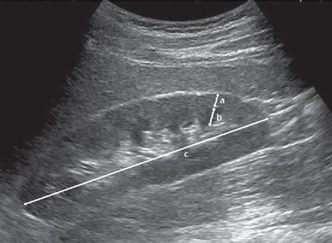 Figure 2 from Left Renal Cortical Thickness Measured by Ultrasound Can Predict Early Progression ...