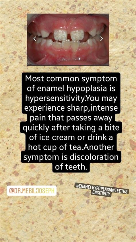 Symptoms of enamel hypoplasia | Teeth dentist, Dentistry, Dentist