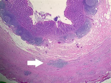 Cureus | Appendiceal Goblet Cell Adenocarcinoma Case Report and Review of the Literature