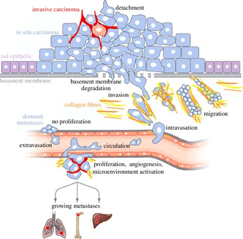 Stages Of Tumor Development And Mechanism Of Metastasis Download