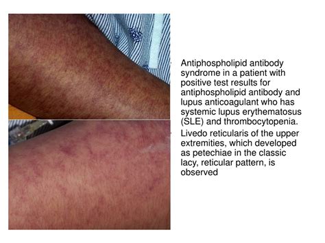 PPT - Antiphospholipid syndrome PowerPoint Presentation, free download - ID:9103764