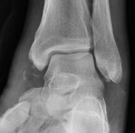 Avulsion injury | Radiology Reference Article | Radiopaedia.org