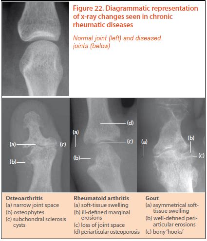 x ray rheumatoid arthritis vs osteoarthritis - Google Search | Arthritis, Rheumatoid arthritis ...