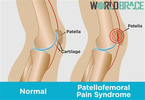 What Is Patellofemoral Pain Syndrome (PPS)? - WorldBrace