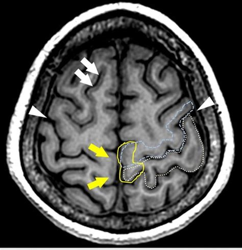 Relationship of the paracentral lobule with other structures. The ...