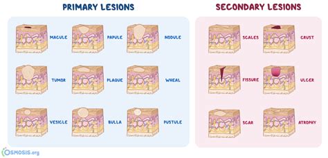 Skin Lesions: What Are They, Types, Causes, Diagnosis, Treatment, and ...