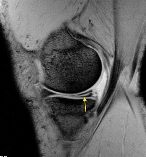 Meniscal tear - Radiology at St. Vincent's University Hospital