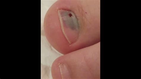 How To Pop Blood Blister Under Toenail - Nail Ftempo