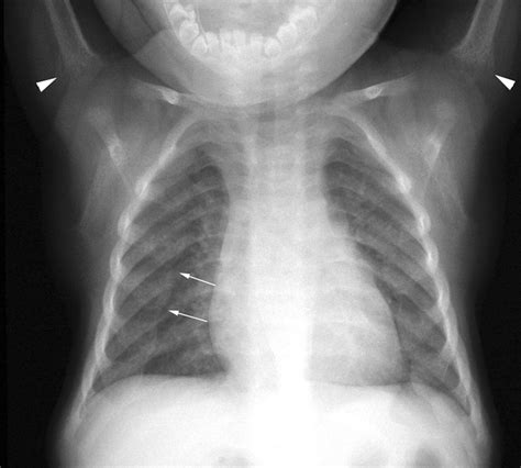 Rickets Disease X Rays