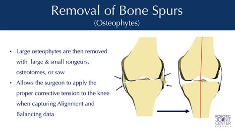 NYC Mako Robotic Total Knee Replacement | Dr. Frederick Buechel, Jr.