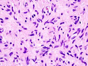 Neurofibroma - Libre Pathology