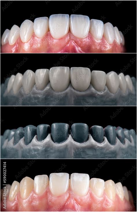 before and after picture of ceramic restorations on teeth by emax and zirkon crowns and veneers ...