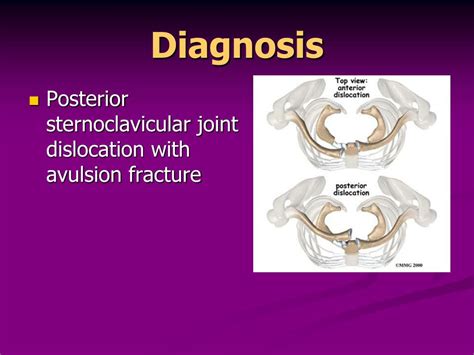 PPT - Sternoclavicular joint dislocation PowerPoint Presentation, free ...